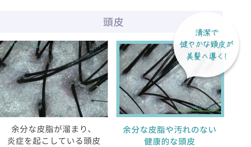 頭皮  清潔で健やかな頭皮が美髪へ導く!  余分な皮脂が溜まり、 炎症を起こしている頭皮  余分な皮脂や汚れのない健康的な頭皮