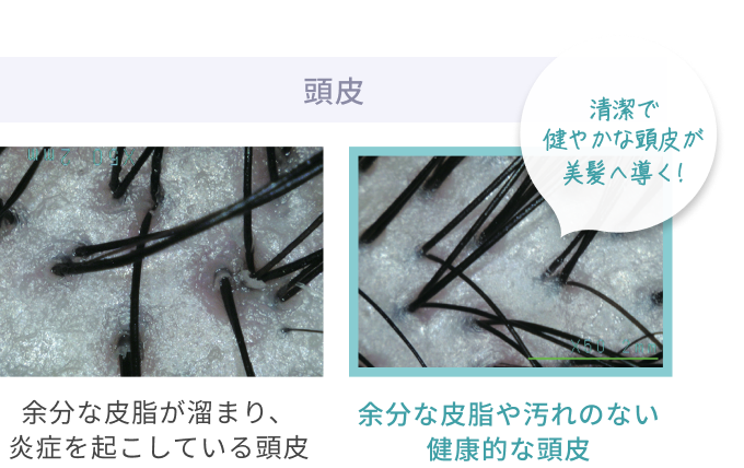 頭皮  清潔で健やかな頭皮が美髪へ導く!  余分な皮脂が溜まり、 炎症を起こしている頭皮  余分な皮脂や汚れのない健康的な頭皮