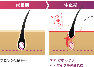 成長期 成長し続けるはずの髪が・・・ 休止期 フケ・かゆみから一気に成長が止まり脱毛！