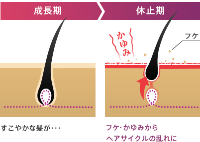 成長期 成長し続けるはずの髪が・・・ 休止期 かゆみ フケ フケ・かゆみから一気に成長が止まり脱毛！