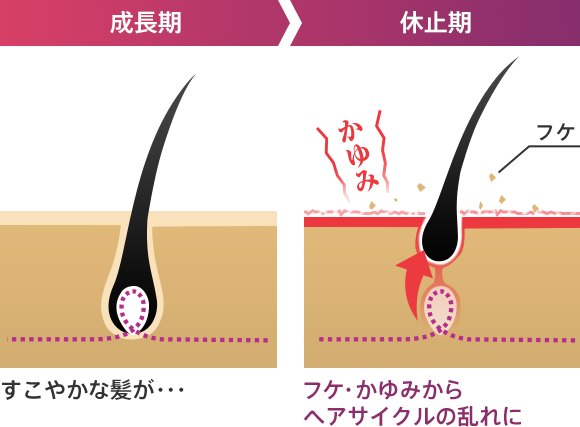 成長期 成長し続けるはずの髪が・・・ 休止期 かゆみ フケ フケ・かゆみから一気に成長が止まり脱毛！